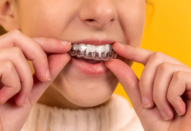 young woman in a jumper smiling wearing a teeth whitening kit